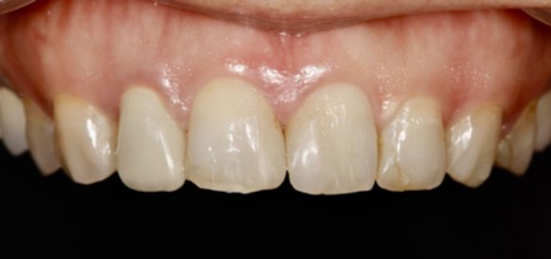 60代男性の前歯のセラミック治療：術前